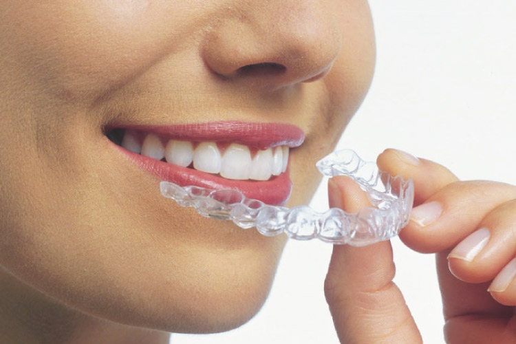 clear aligners in Rajkot, Gujarat
