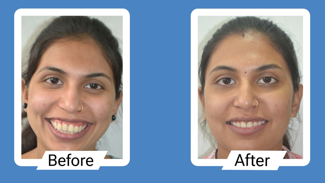 clear aligners in rajkot